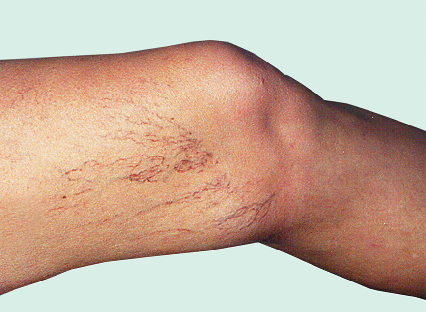 Spider Veins – Carolina Vein Center, Durham, Raleigh, Pinehurst