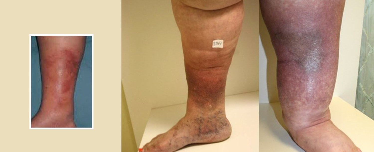 Chronic Venous Insufficiency - Vein Specialists of the Carolinas