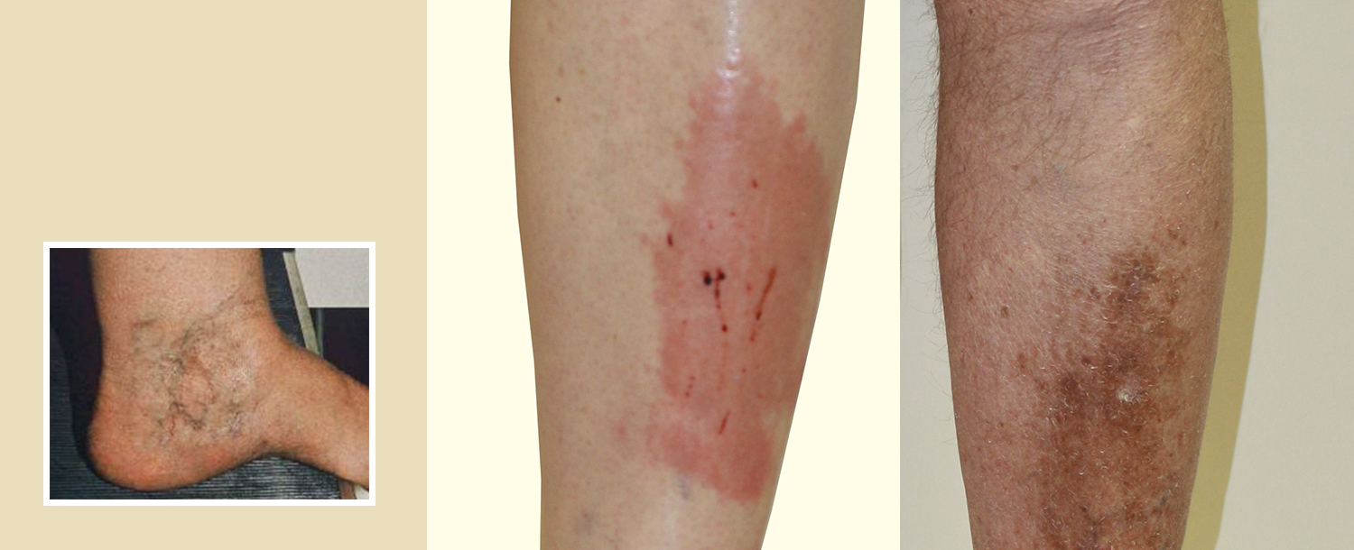 Skin Changes In Venous Insufficiency - Laurel Clinical